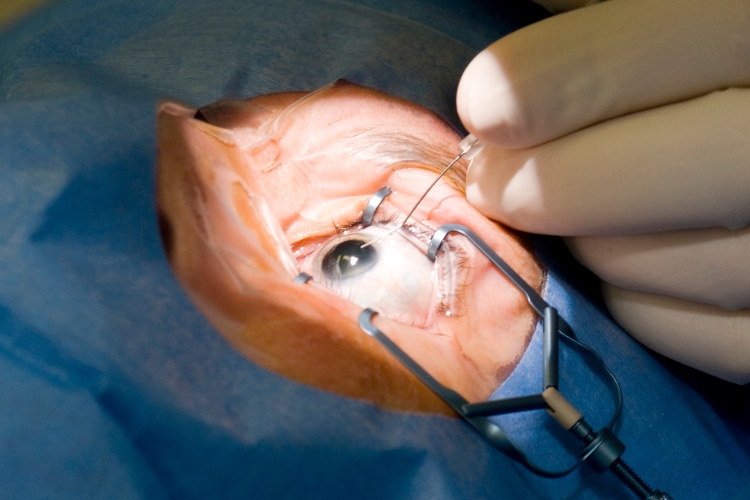 Cataract Phacoemulsification Surgery